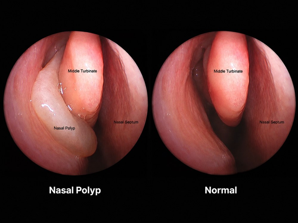 Endoscopic view comparing a nasal polyp beside the middle turbinate and nasal septum, next to a normal nasal cavity for comparison.