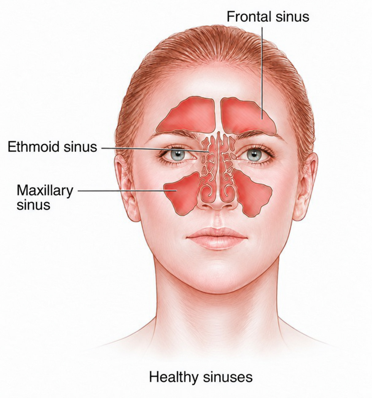 Diagram of normal sinus anatomy, labelled frontal sinus, ethmoid sinus and maxillary sinus, shown on a front view of the face.