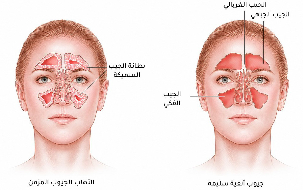 رسم يقارن بين الجيوب الأنفية السليمة والتهاب الجيوب الأنفية المزمن، موضحًا الجيوب الجبهية والغربالية والفكية، مع سماكة واضحة في بطانة الجيوب المصابة بالالتهاب المزمن.