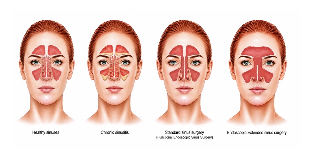 Diagram comparing healthy sinuses, chronic sinusitis, standard sinus surgery, and endoscopic extended sinus surgery, showing progressively larger sinus openings.